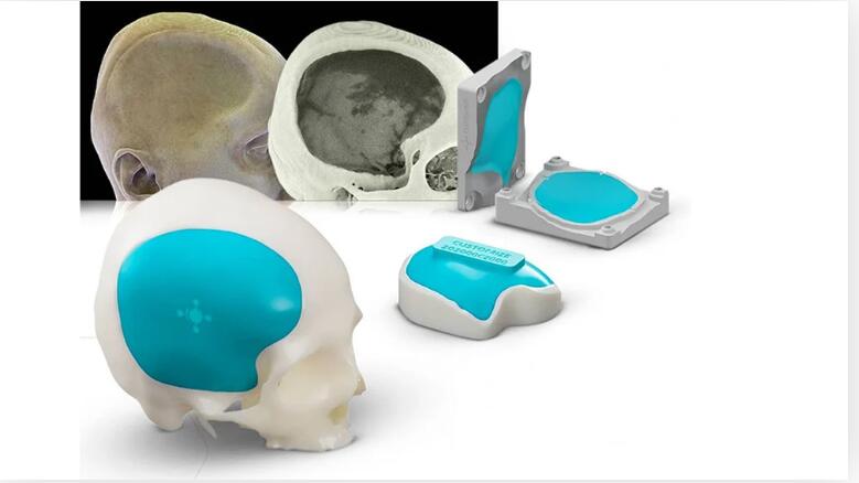 3D打印颅骨植入物成型模具.jpg